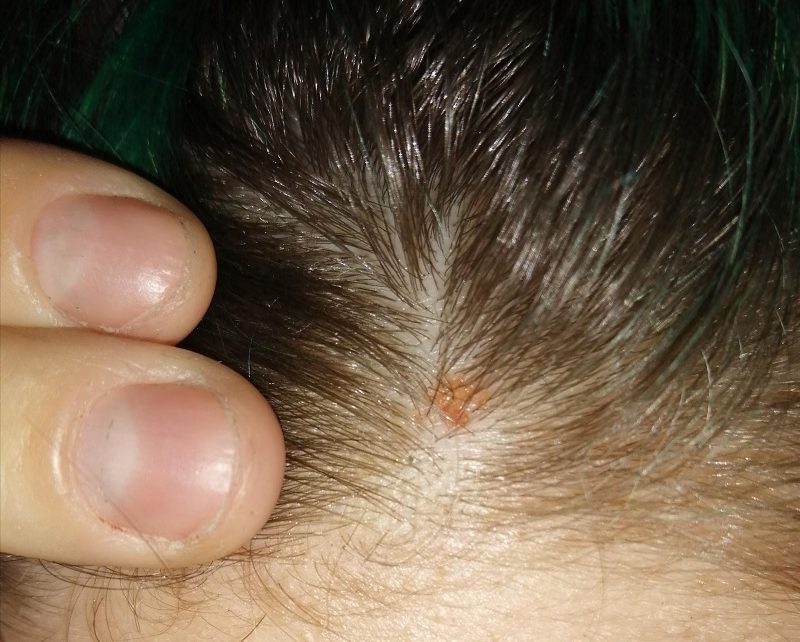 how-to-treat-scabs-on-the-scalp-bos-bbq